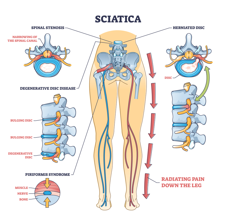 sciatica treatment niiramayam arogya kendra prayagraj allahabad